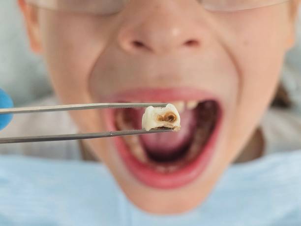 Teeth Whitening in SC